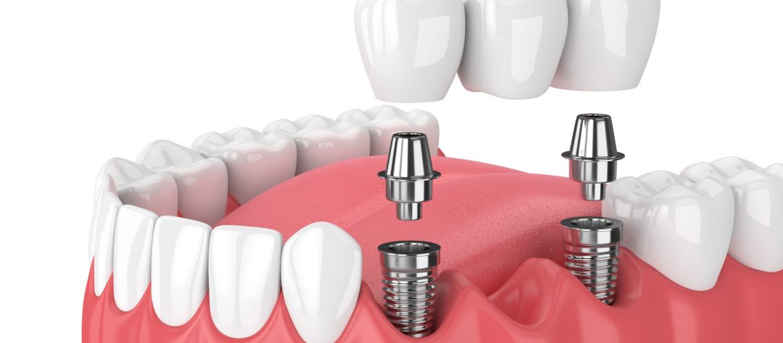 dental implant feat 2